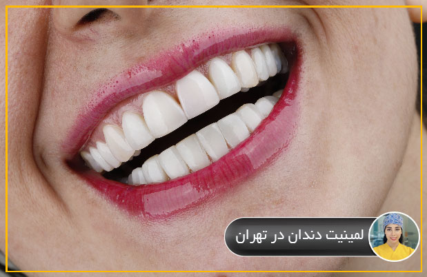 لمینیت دندان در تهران
