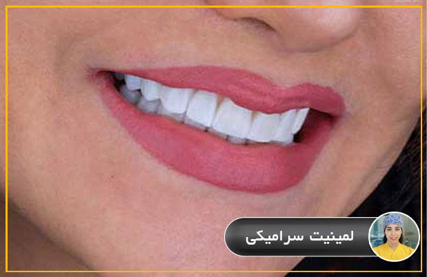 لمینیت دندان چیست؟