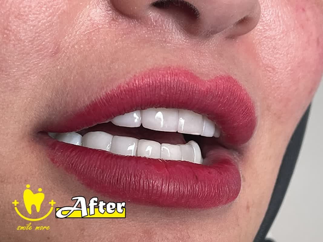 لمینت دندان در تهران در بهترین مطب دندانپزشکی